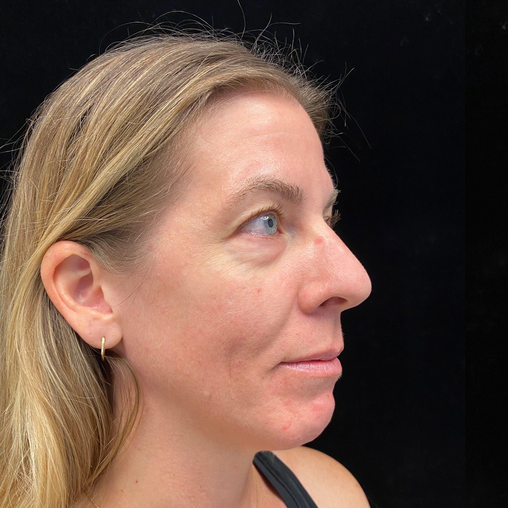 Before- Full Face rejuvenation with fillers
